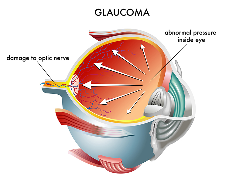 Glaucoma can damage the eye’s optic nerve, which slowly impairs vision